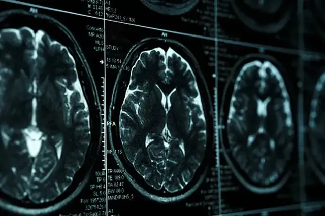 brain injuries shown on a CT scan